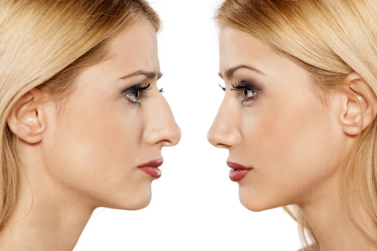 Quais são os benefícios da cirurgia plástica? 15 cirurgia plastica rinoplastia