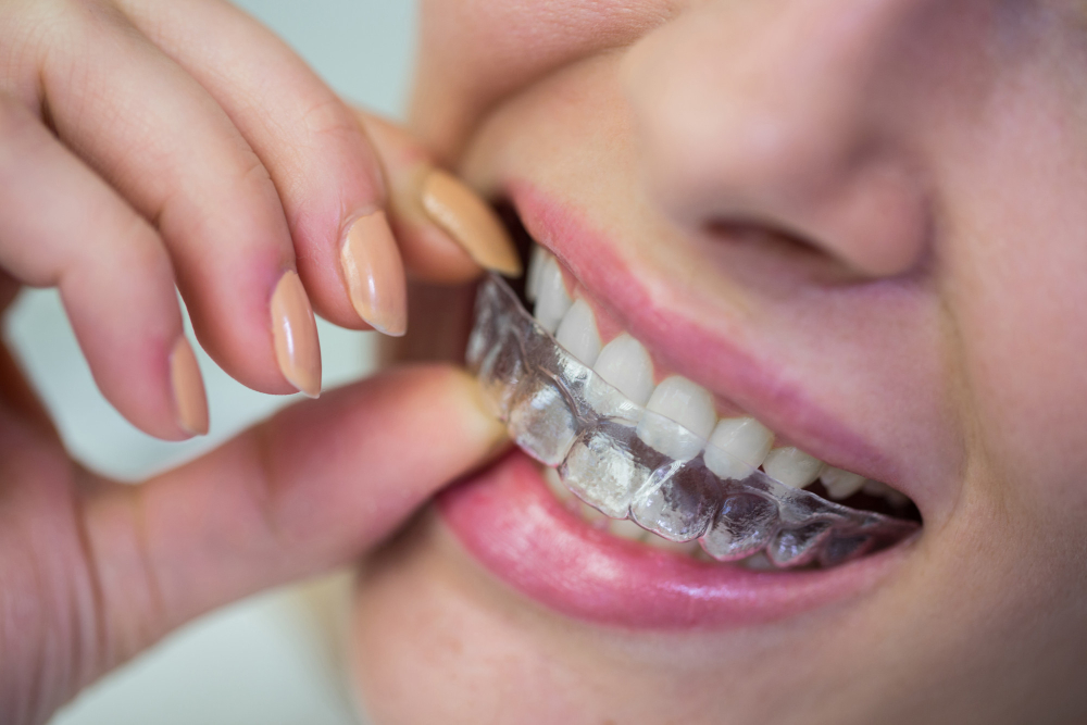Quais são os benefícios da limpeza de dentes? 1 benefícios da limpeza de dentes